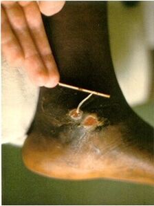 Guinea worm extracted from the leg of a person with dracunculiasis