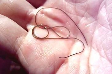 a worm parasite from the human body